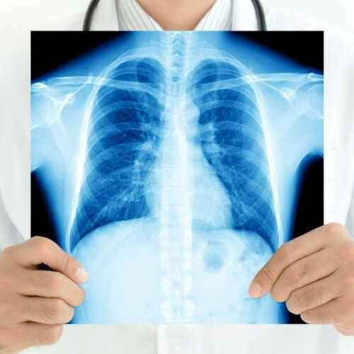 Туберкулез – тегеуіріні қатты жұқпалы дерт